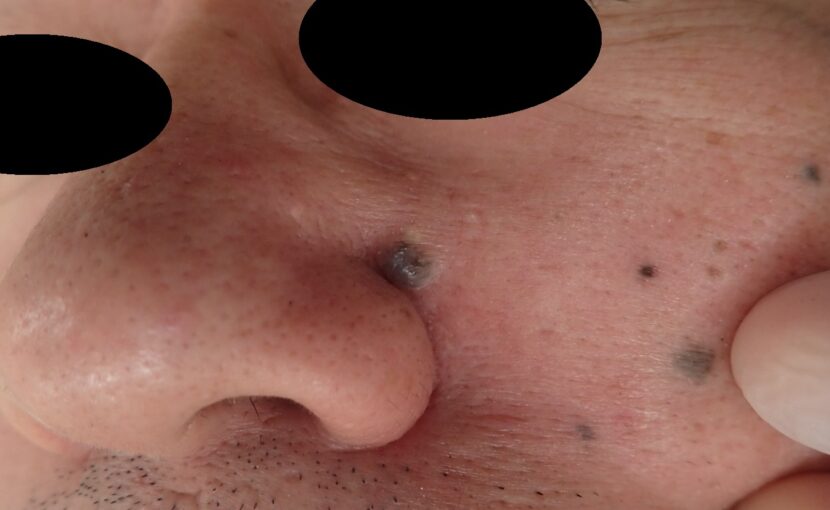 顔のほくろ切除術前写真。10年以上前からある黒子が大きくなり、切除を希望された50代男性。