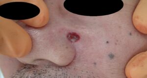 Facial Mole Excision (Male, 50s) | Postop Day 3 - 粉瘤(アテローム) | こおりたひろ整形形成外科クリニック - 痛みの少ない粉瘤治療で多数の実績|大阪| Postoperative day 3 photo after facial mole removal using punch excision. No bleeding or infection, managed with Natsui moist therapy.