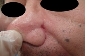Facial Mole Excision (Male, 50s) | Postop Day 32 - 粉瘤(アテローム) | こおりたひろ整形形成外科クリニック - 痛みの少ない粉瘤治療で多数の実績|大阪| Postoperative day 32 photo after facial mole removal using punch excision. No pain or infection. Wound completely healed.