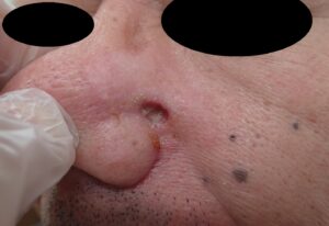 Facial Mole Excision (Male, 50s) | Postop Day 6 - 粉瘤(アテローム) | こおりたひろ整形形成外科クリニック - 痛みの少ない粉瘤治療で多数の実績|大阪| Postoperative day 6 photo after facial mole removal using punch excision. No bleeding, infection, or pain. Managed with Natsui moist therapy.