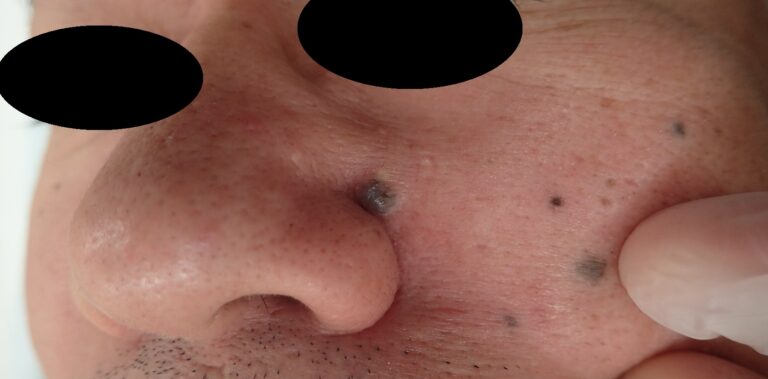 Preoperative photo of facial mole excision. Male in his 50s with a mole present for over 10 years that recently enlarged.