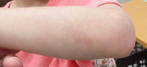 Four-year follow-up photo showing a completely scar-free forearm in a girl injured at 1 year 4 months.