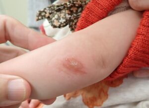 Day 1 photo of a 1-year-4-month-old girl showing a healing forearm laceration with no bleeding, improving under moist wound care.