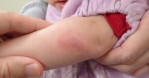 Day 7 photo showing a nearly healed forearm laceration in a 1-year-4-month-old girl, with no infection and no use of disinfection or antibiotics.