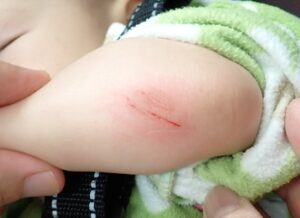 1歳4か月女児の前腕挫創|初診時(なつい式湿潤療法) - 粉瘤(アテローム) | こおりたひろ整形形成外科クリニック - 痛みの少ない粉瘤治療で多数の実績|大阪| 1歳4か月女児の前腕挫創の初診時写真。軽度の出血と擦過傷を認める状態。