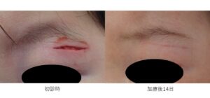 eyelid-laceration-1yo-before-after-moist-taping-14days - 粉瘤(アテローム) | こおりたひろ整形形成外科クリニック - 痛みの少ない粉瘤治療で多数の実績|大阪| 1歳児のまぶたの割創のBefore After比較写真|湿潤療法とテーピングで初診時から14日後にきれいに治癒した症例
