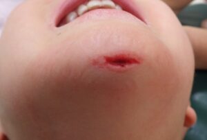 Initial presentation of a chin laceration in a 2-year-old child. The wound was treated without suturing using Natsui-style moist care.
