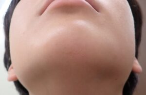 顎部割創(2歳)術後11年の状態|なつい式湿潤療法後、ほぼ傷跡わからず - 粉瘤(アテローム) | こおりたひろ整形形成外科クリニック - 痛みの少ない粉瘤治療で多数の実績|大阪| 2歳時に顎部割創を受傷し、縫合せずなつい式湿潤療法で治療した症例の術後11年写真。成長後の日常生活では、ほぼ傷跡が分からない状態。