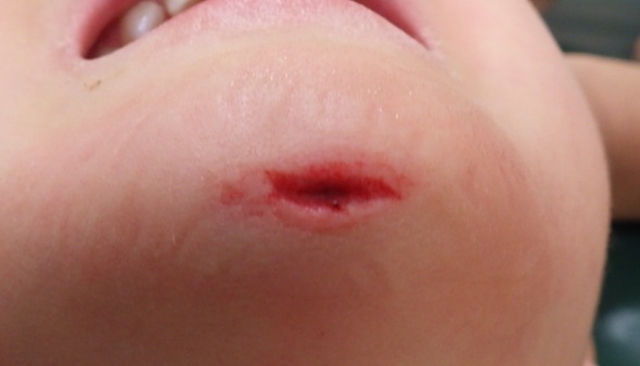 2y-gakubu-kassou-shoshinji-natsui-moistcare-1 - 粉瘤(アテローム) | こおりたひろ整形形成外科クリニック - 痛みの少ない粉瘤治療で多数の実績|大阪|