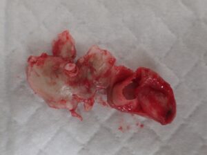 Photograph of the excised capsule from an inflamed epidermoid cyst on the abdomen