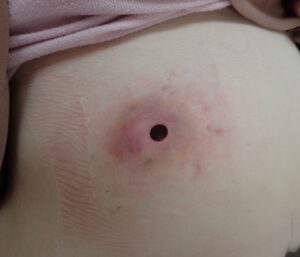 Postoperative day 1 image of an inflamed epidermoid cyst on the abdomen showing minimal bleeding and pain after punch excision