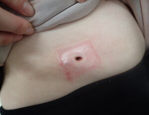 Postoperative day 12 image of an inflamed epidermoid cyst on the abdomen showing no bleeding or pain after punch excision