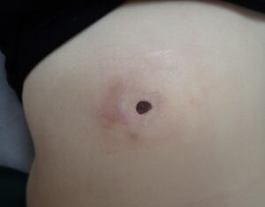 Postoperative day 5 image of an inflamed epidermoid cyst on the abdomen showing minimal oozing and no pain after punch excision