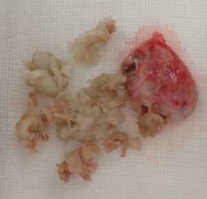 Specimen photo of an excised epidermoid cyst from the right temple of a woman in her 50s. The left side shows the cyst contents, and the right side shows the capsule.