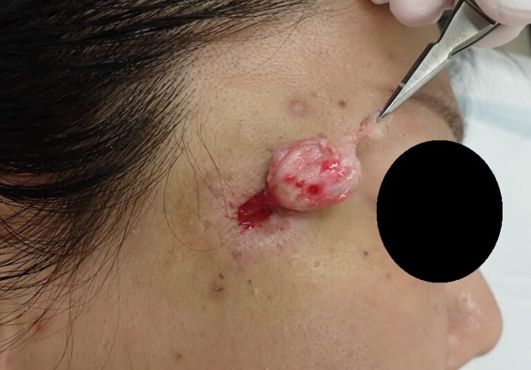 Close-up intraoperative image showing capsule removal of an epidermoid cyst on the right temple of a woman in her 50s using the punch excision technique.