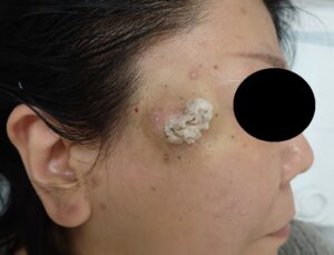 Intraoperative image showing drainage of the contents of an epidermoid cyst on the right temple of a woman in her 50s. Minimal bleeding is observed.