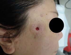 Immediate postoperative image following punch excision of an epidermoid cyst on the right temple of a woman in her 50s. Minimal bleeding and a small, clean wound.