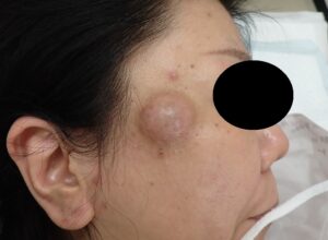 Preoperative image of an epidermoid cyst on the right temple in a woman in her 50s, scheduled for punch excision.