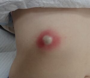 腹部にできた炎症性粉瘤の術前写真。赤く腫れ、強い痛みを伴っていた状態