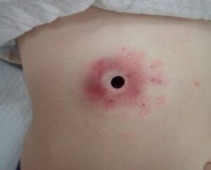 腹部の炎症性粉瘤をくりぬき法で手術直後、ほぼ出血を認めない創部の写真