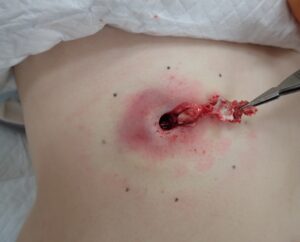 腹部の炎症性粉瘤をくりぬき法で手術中、袋（被膜）を摘出している術中写真