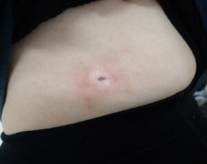 腹部の炎症性粉瘤をくりぬき法で手術後25日目、ほぼ治癒し症状を認めない創部の写真