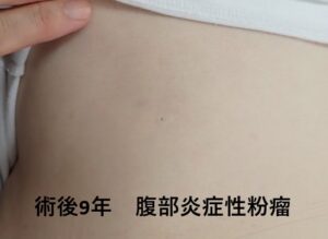 腹部の炎症性粉瘤をくりぬき法で手術後9年、傷跡がほぼ分からない状態を示すサムネイル画像