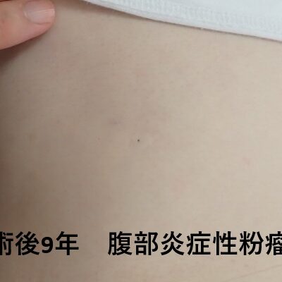 腹部の炎症性粉瘤をくりぬき法で手術後9年、傷跡がほぼ分からない状態を示すサムネイル画像
