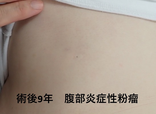 腹部の炎症性粉瘤をくりぬき法で手術後9年、傷跡がほぼ分からない状態を示すサムネイル画像