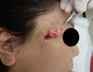 粉瘤(顔・50代女性)術中写真|被膜を丸ごと摘出|くりぬき法 - 粉瘤(アテローム) | こおりたひろ整形形成外科クリニック - 痛みの少ない粉瘤治療で多数の実績|大阪| 右こめかみの粉瘤(50代女性)をくりぬき法で被膜ごと摘出している術中写真。袋を完全に除去している場面。