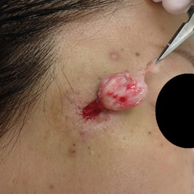 右こめかみの粉瘤（50代女性）の被膜をくりぬき法で摘出している拡大術中写真。袋が鮮明に見える場面。