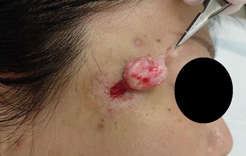 粉瘤(顔・50代女性)術中|被膜摘出の拡大写真|くりぬき法 - 粉瘤(アテローム) | こおりたひろ整形形成外科クリニック - 痛みの少ない粉瘤治療で多数の実績|大阪| 右こめかみの粉瘤(50代女性)の被膜をくりぬき法で摘出している拡大術中写真。袋が鮮明に見える場面。