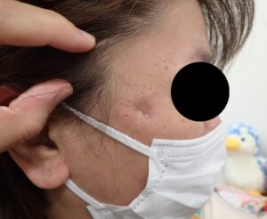 粉瘤(顔・50代女性)術後1年10か月|痛み・違和感なし|傷跡ほぼ分からず - 粉瘤(アテローム) | こおりたひろ整形形成外科クリニック - 痛みの少ない粉瘤治療で多数の実績|大阪| 右こめかみの粉瘤(50代女性)術後1年10か月の写真。痛みや違和感は全くなく、傷跡はほとんど認められない。