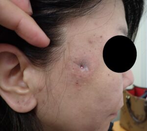 粉瘤(顔・50代女性)術後9日目|上皮化が進行|痛み・出血ほぼなし - 粉瘤(アテローム) | こおりたひろ整形形成外科クリニック - 痛みの少ない粉瘤治療で多数の実績|大阪| 右こめかみの粉瘤(50代女性)術後9日目の写真。痛みや出血はほぼなく、創部は上皮化が進んでいる。