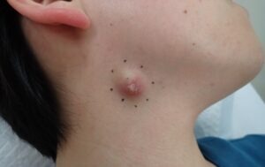 Preoperative image of an inflamed epidermoid cyst on the neck with redness and pain in a woman in her 40s