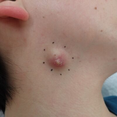 Preoperative image of an inflamed epidermoid cyst on the neck with redness and pain in a woman in her 40s