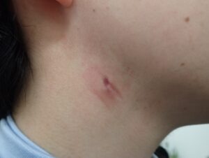 Postoperative day 13 image after punch excision of a neck epidermoid cyst, showing a nearly healed wound with no symptoms