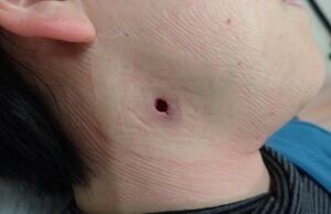 Postoperative day 2 image after punch excision of a neck epidermoid cyst, showing minimal bleeding, swelling, and pain in a woman in her 40s