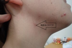 Postoperative day 79 image after punch excision of a neck epidermoid cyst, showing a scar that is barely visible