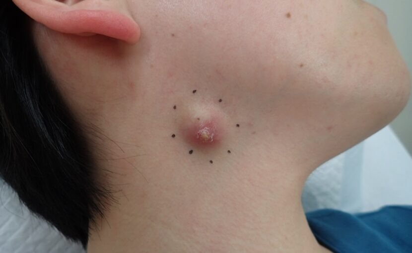 炎症により赤く腫れ、痛みを伴っていた頚部粉瘤の術前写真（40代女性）