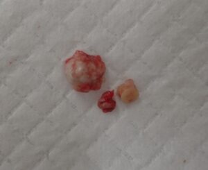 くりぬき法により被膜ごと摘出された頚部粉瘤の標本写真（40代女性）