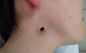 くりぬき法で頚部粉瘤を摘出した直後の写真。出血はほぼ認められない（40代女性）