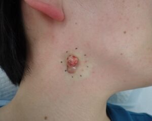 炎症性の頚部粉瘤に対し、くりぬき法で被膜を剥離・摘出している術中写真（40代女性）