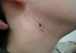 くりぬき法で頚部粉瘤を摘出後5日目の写真。腫れ・出血・痛みは認められず、創の深さも浅くなっている（40代女性）