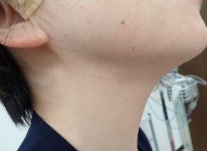 くりぬき法で頚部粉瘤を摘出後8年の写真。傷跡は全く分からず、手術部位も判別できない状態（40代女性）