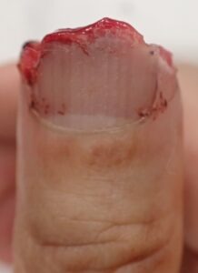 Dorsal view of a thumb with fingertip amputation caused by an electric saw, showing loss of the nail and skin, a condition typically considered for flap surgery or stump revision.