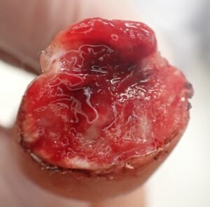 Frontal view of a thumb with fingertip amputation caused by an electric saw, showing loss of the nail and skin, typically considered for flap surgery or stump revision.