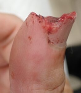 Left lateral view of a thumb with fingertip amputation caused by an electric saw, showing loss of the nail and skin, typically considered for flap surgery or stump revision.