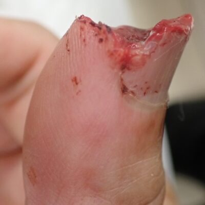 Left lateral view of a thumb with fingertip amputation caused by an electric saw, showing loss of the nail and skin, typically considered for flap surgery or stump revision.