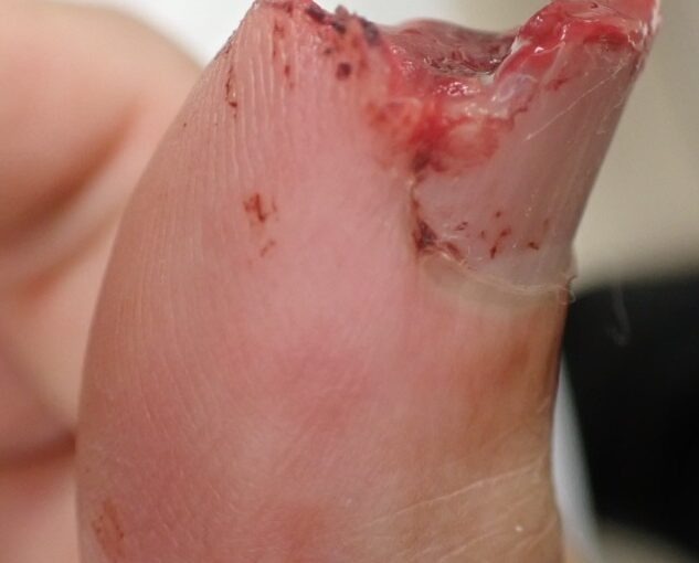 Left lateral view of a thumb with fingertip amputation caused by an electric saw, showing loss of the nail and skin, typically considered for flap surgery or stump revision.